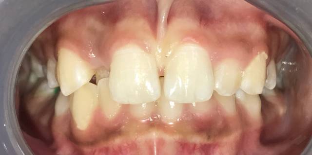 Before Traditional Braces Patient 1