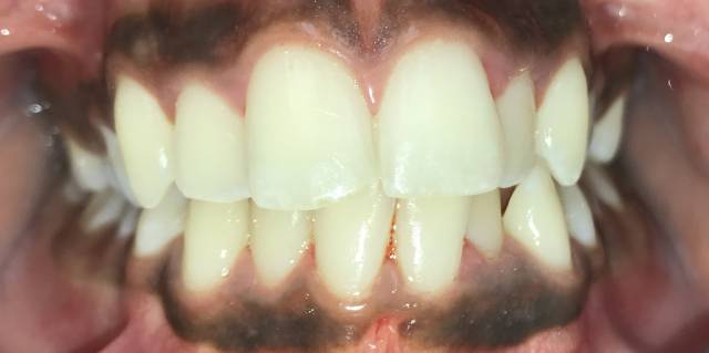 Before Traditional Braces Patient 2