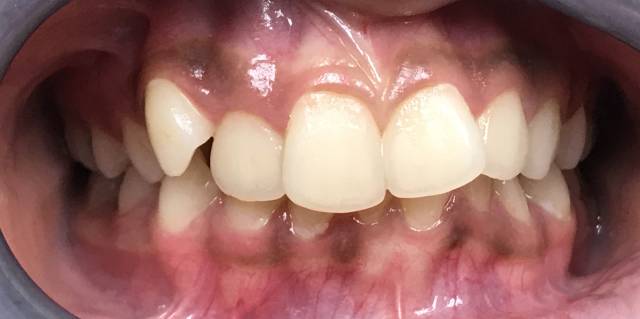 Before Traditional Braces Patient 3