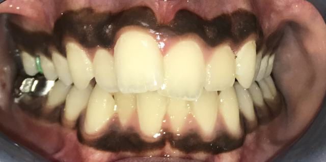 Before Traditional Braces Patient 5