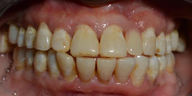 After Dental Denture