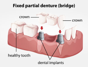 Fixed Partial Dentures