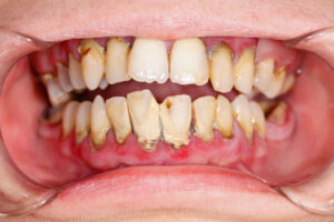 Tooth decay - Dental Diseases